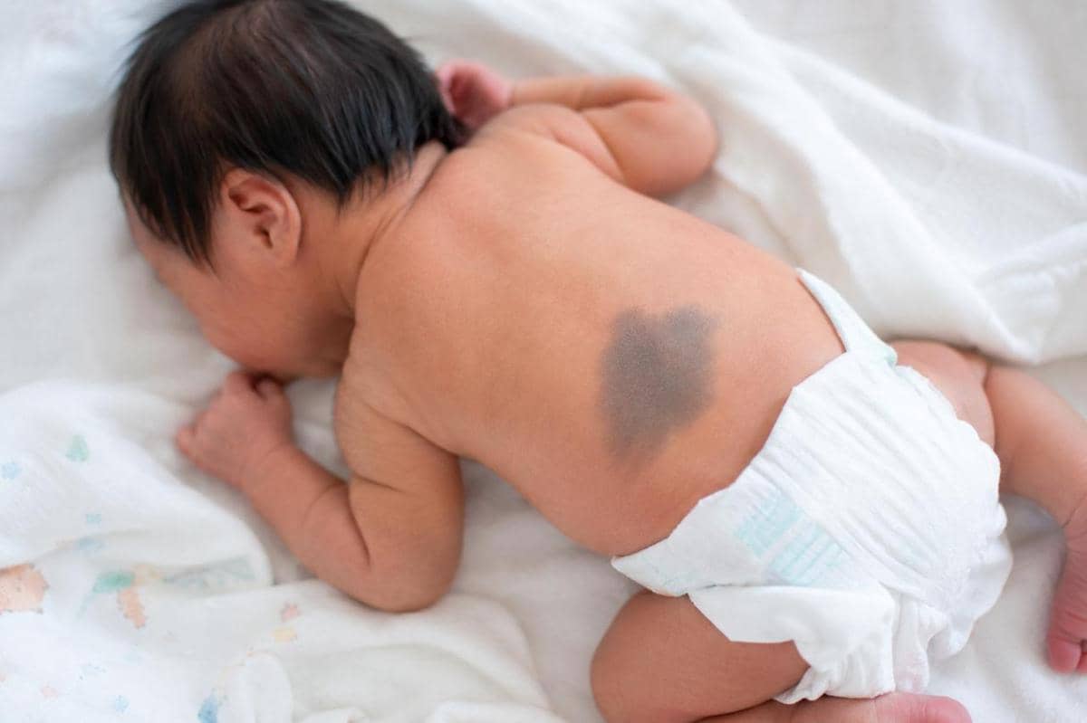 Kondisi pada bayi yang sering dikira berbahaya padahal normal