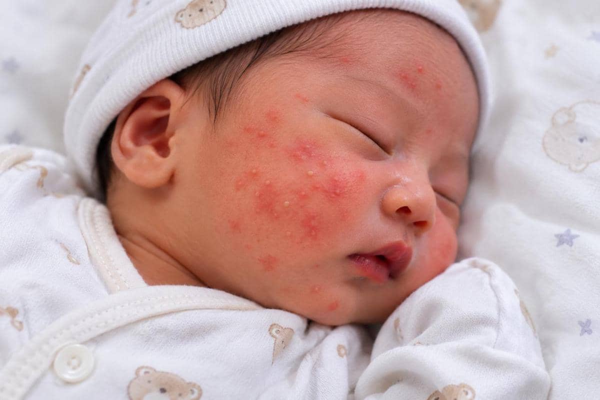 Kondisi pada bayi yang sering dikira berbahaya padahal normal