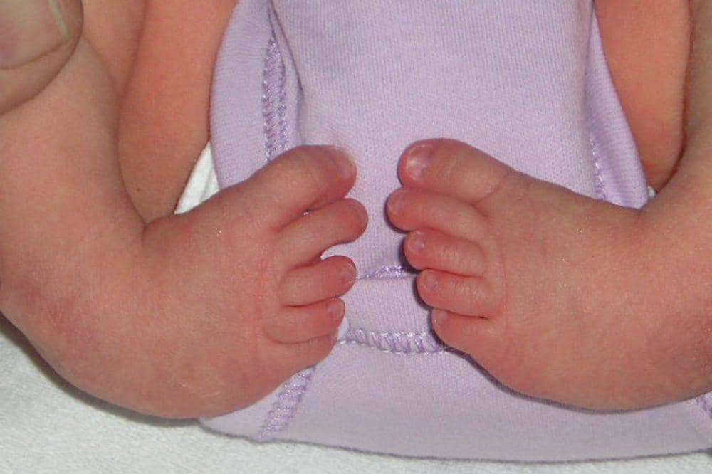 Clubfoot (kaki pengkor)