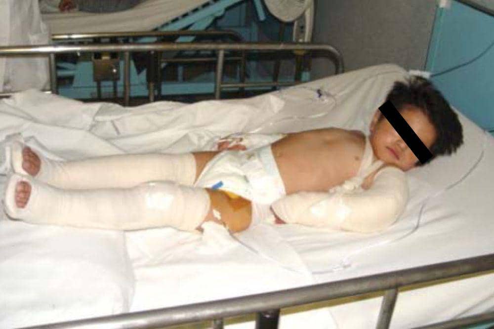 Battered Child Syndrome, Ketika Cerita "Anak Sering Jatuh" Menutupi Kekerasan