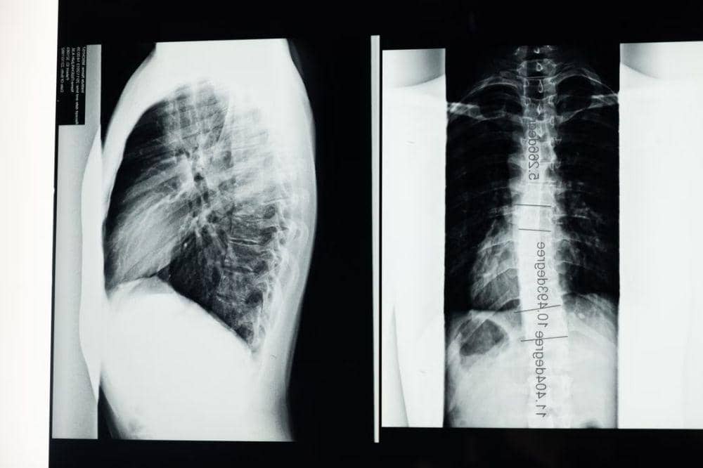 Diagnosis dan Penanganan Hipertensi Portal
