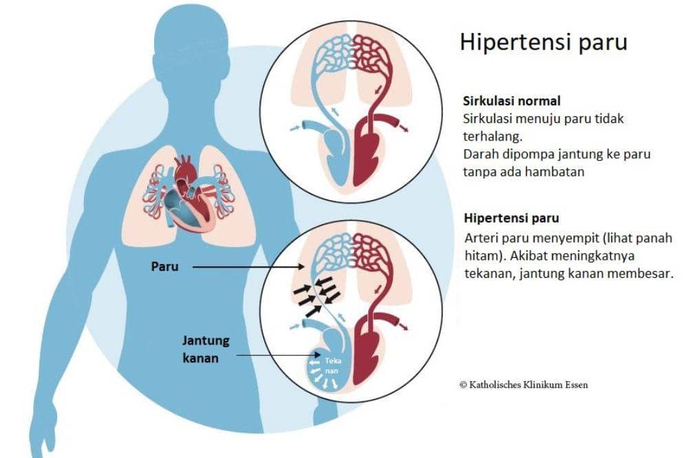 Pengertian Hipertensi Pulmonal