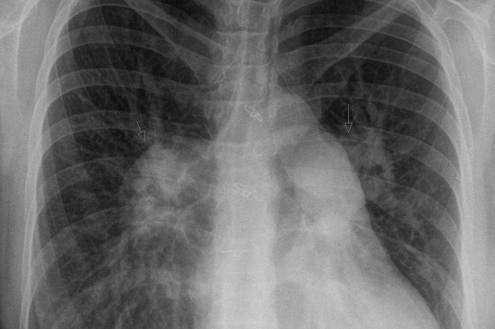 Diagnosis Hipertensi Pulmonal