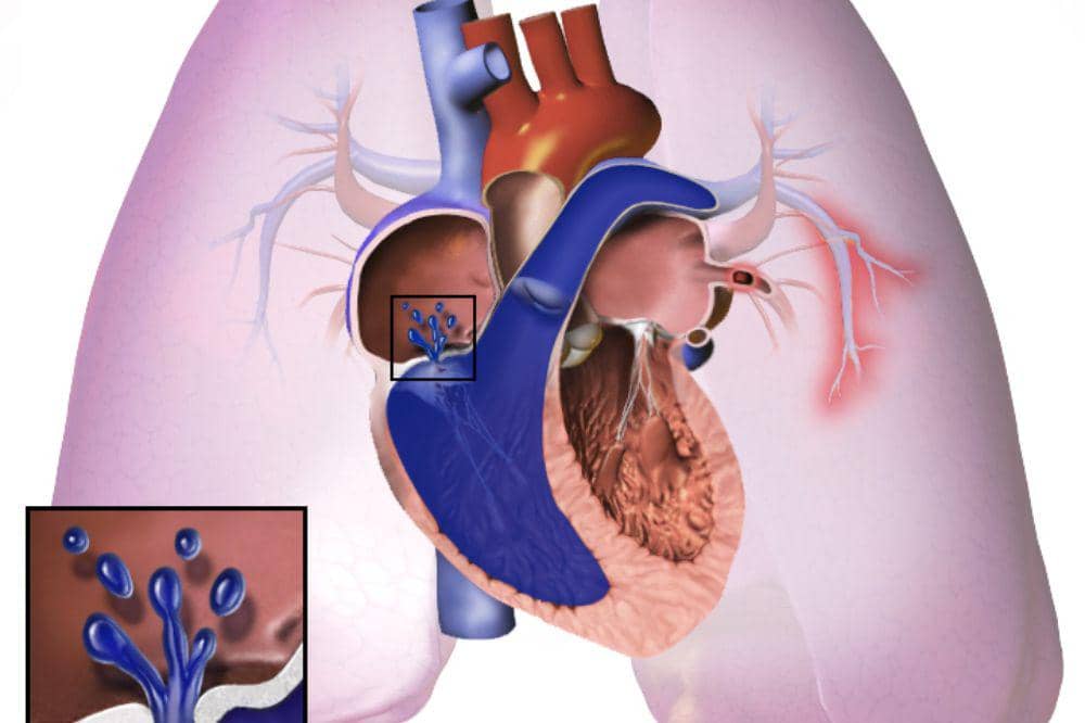 Apa Itu Hipertensi Pulmonal? Kenali Gejala dan Penyebabnya
