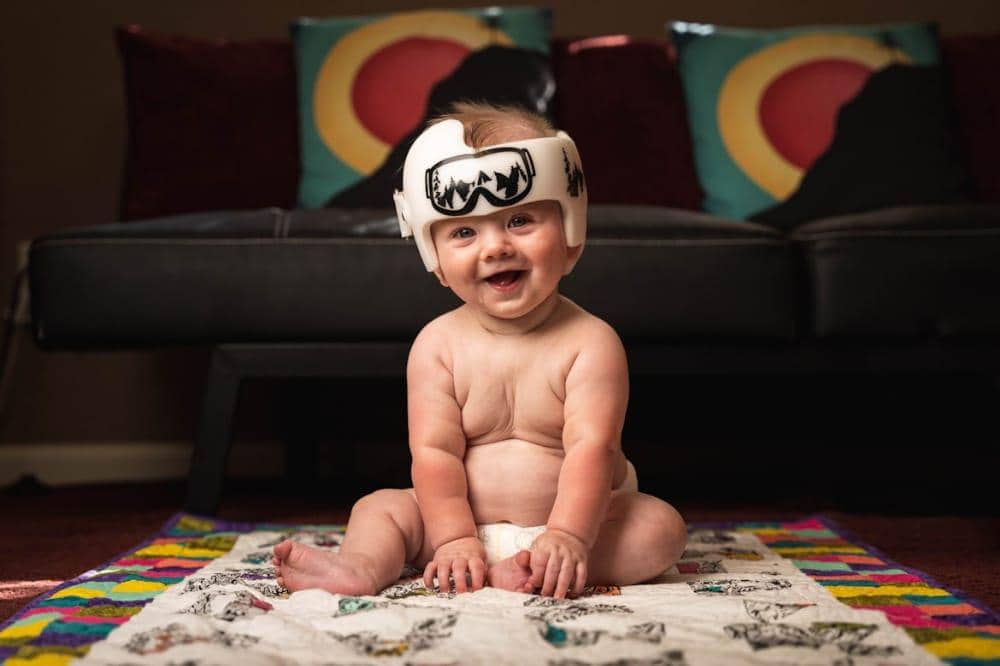 Garis wajah bayi tidak simetris bisa jadi tanda kepala peyang