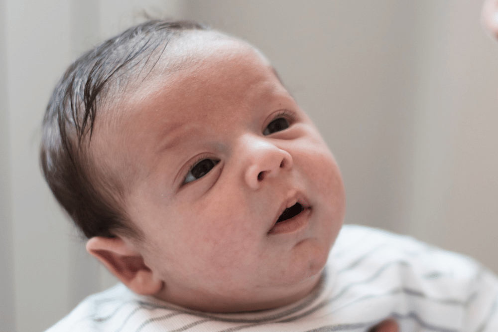 Jerawat bayi