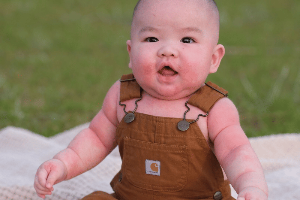 Eksim (Dermatitis atopik)