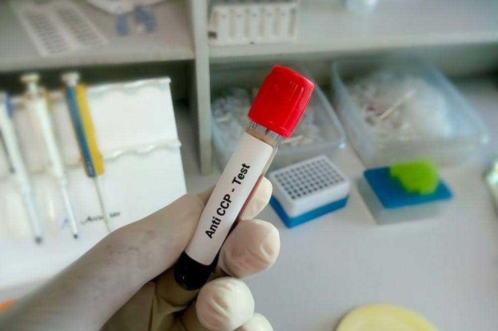Tes Anti-CCP (Anti-Cyclic Citrullinated Peptide)