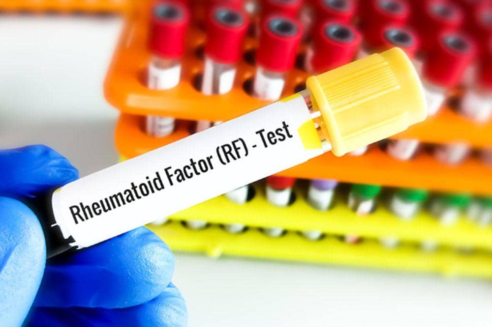 Tes RF (Rheumatoid Factor)