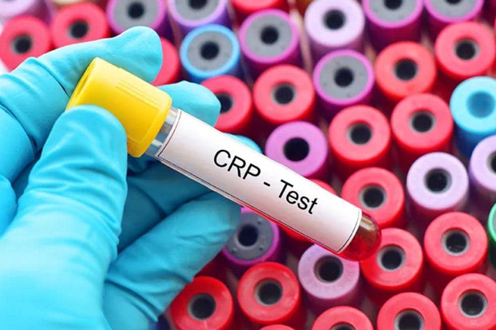 Tes CRP (C-Reactive Protein)