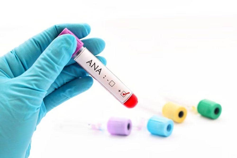 Tes ANA (Antinuclear Antibody)
