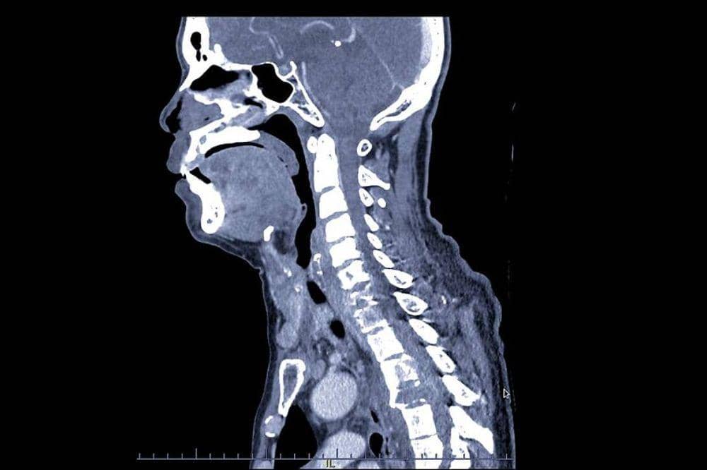 CT-Scan (Computed Tomography Scan)
