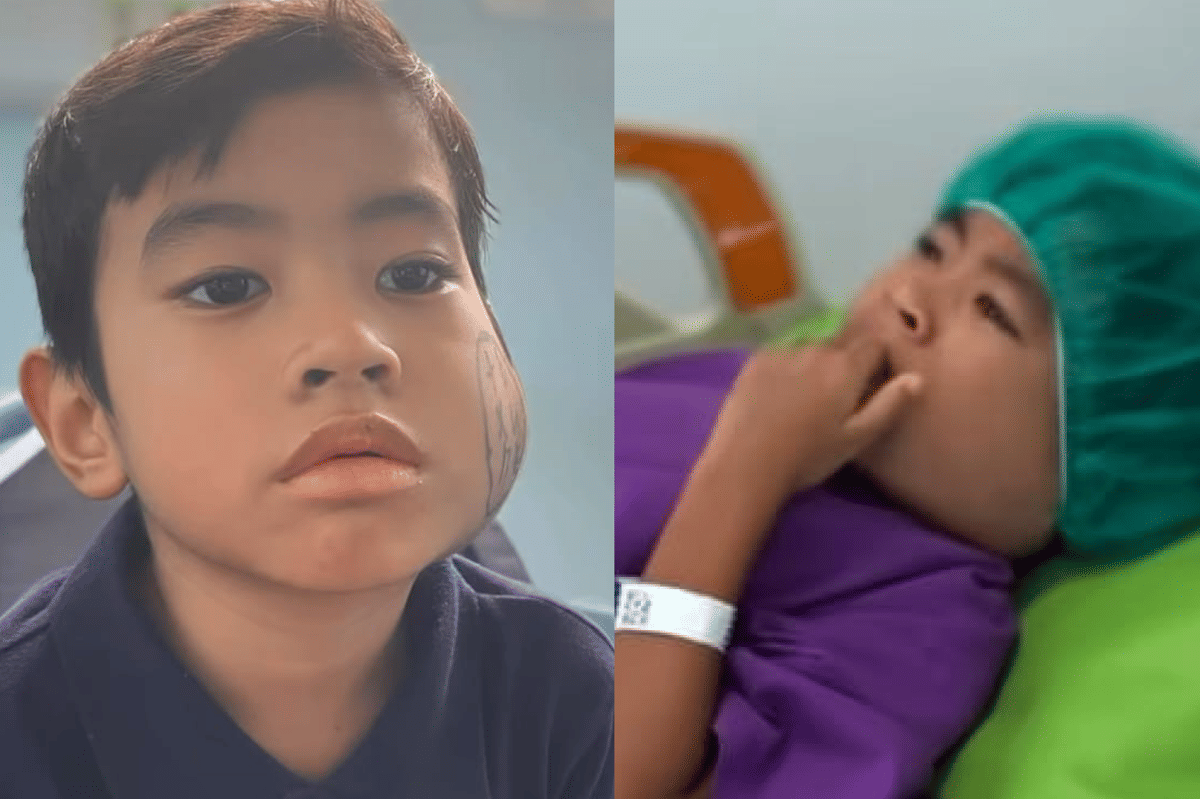 Gigi Susu Anak yang Berlubang Jangan Disepelekan, Ini Risikonya!