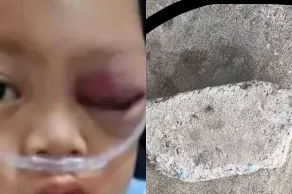Viral! Balita di LamTim Dilempar Batu oleh ODGJ, Mata Sampai Lebam