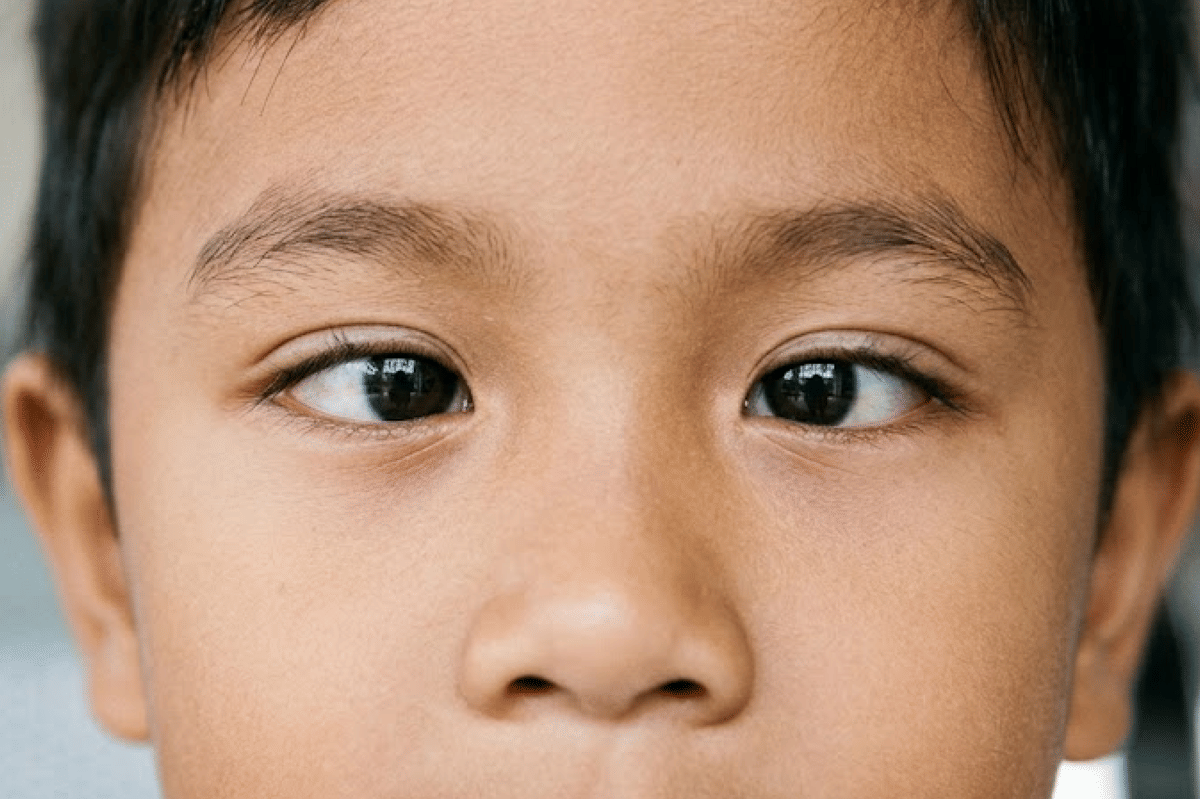 Mata Anak Juling, Haruskah Dioperasi? Ini Penjelasan Dokter!