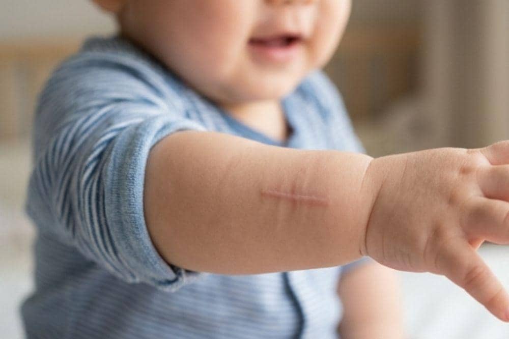 Penyebab luka anak berbekas dan susah hilang
