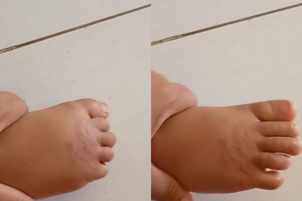 Infeksi Cacing Tambang, Bahaya Anak Barefoot di Rumput yang Mesti Diwaspadai