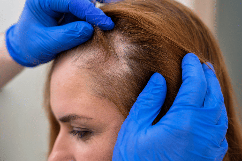Alopecia areata