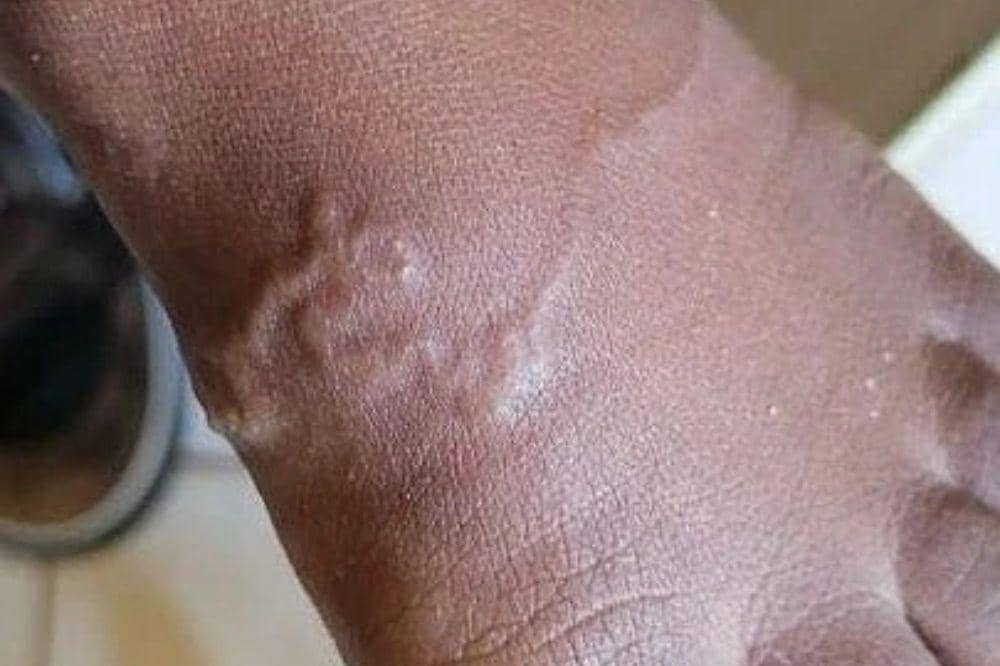 Bahaya cacing tambang pada anak saat barefoot di rumput larva tersebut langsung menembus kuliat anak