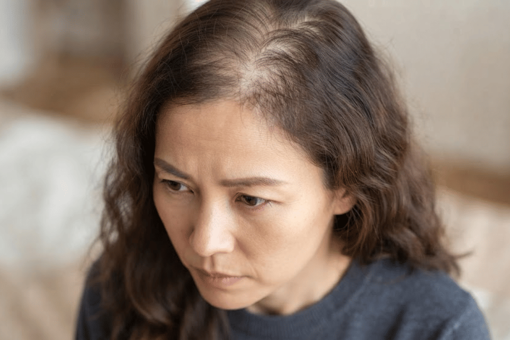 Kenali Penyebab Rambut Makin Tipis dan Berisiko Botak