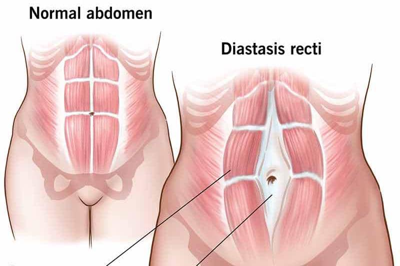 Diastasis Recti