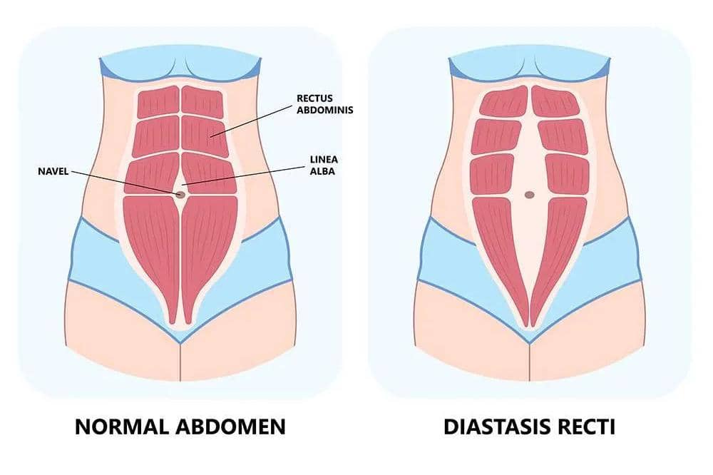 Diastasis Recti
