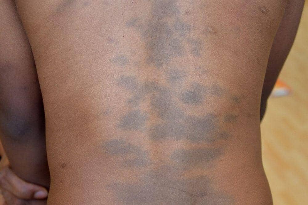 Apa Itu Mongolian Spots? Bercak Biru yang Muncul pada Bayi Baru Lahir