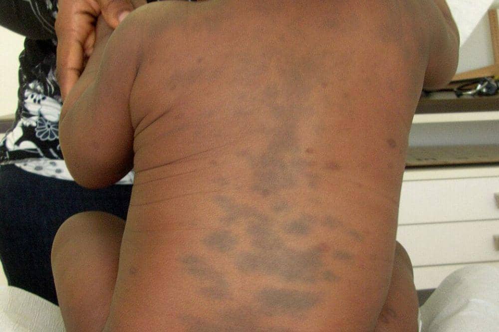 Apa Itu Mongolian Spots?