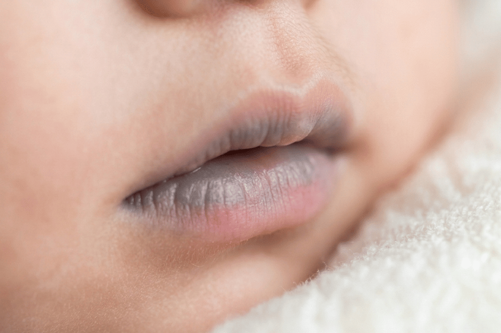 Bibir Bayi Biru Apakah Berbahaya?