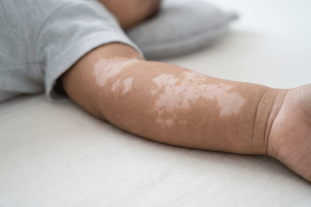 5 Penyebab Bercak Putih pada Kulit Bayi