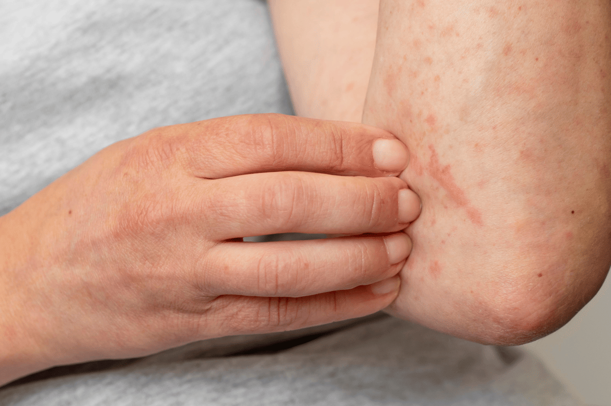 Mengenal postpartum hives (6)