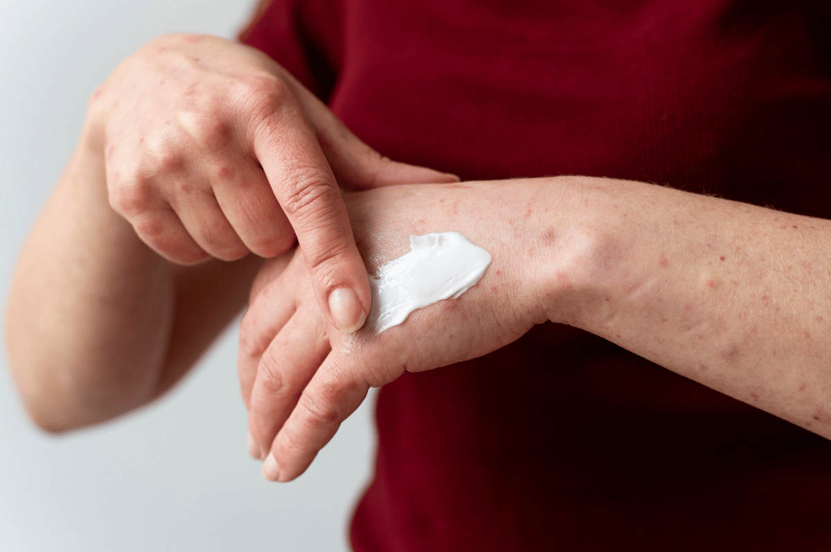 Mengenal postpartum hives (5)