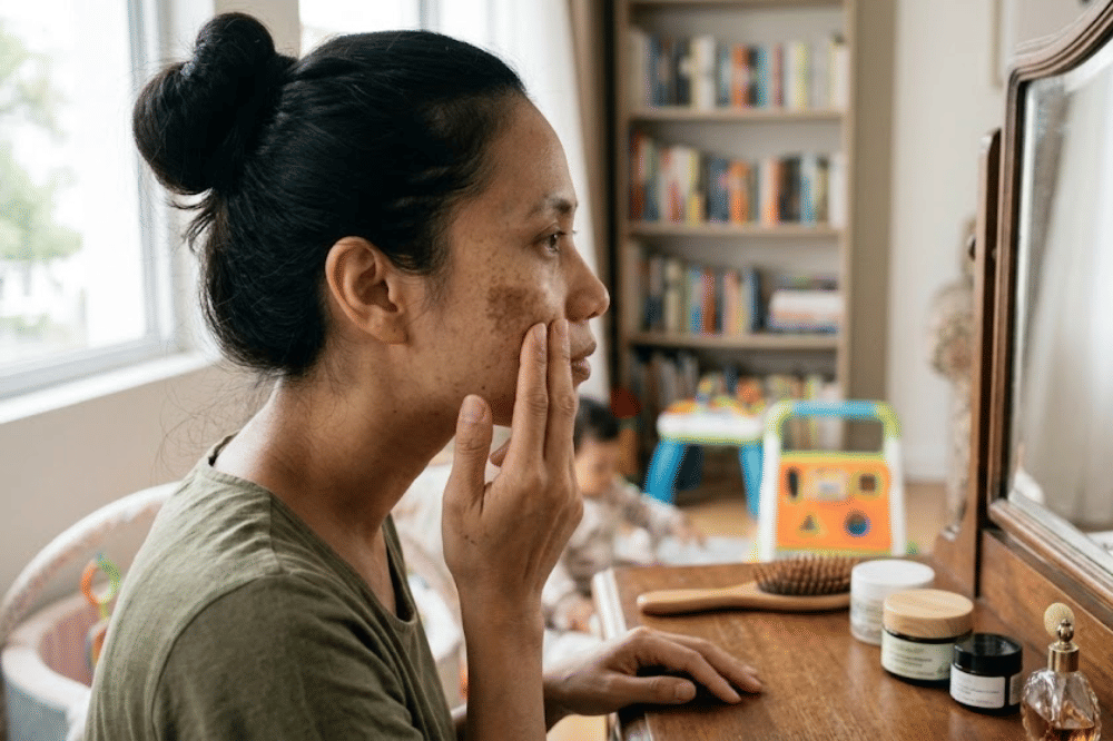 Memahami penyebab dan pemicu melasma pada ibu baru
