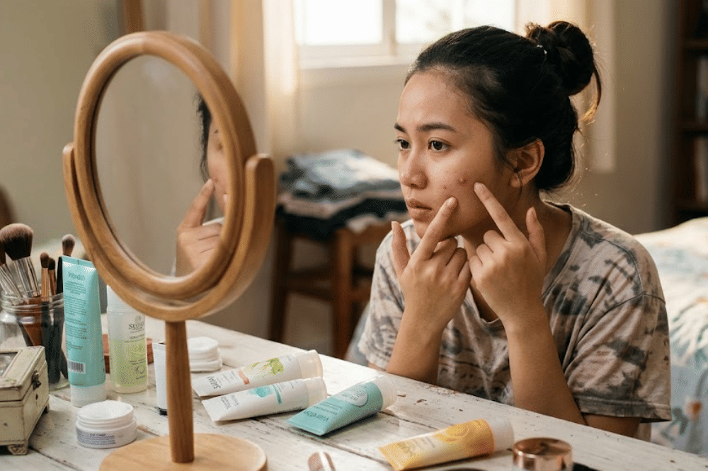 Penyebab dan Cara Mengatasi Postpartum Acne, Jerawat Pascamelahirkan