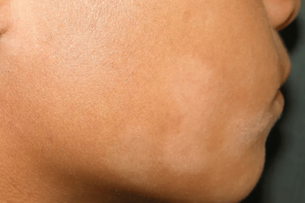 Pityriasis alba