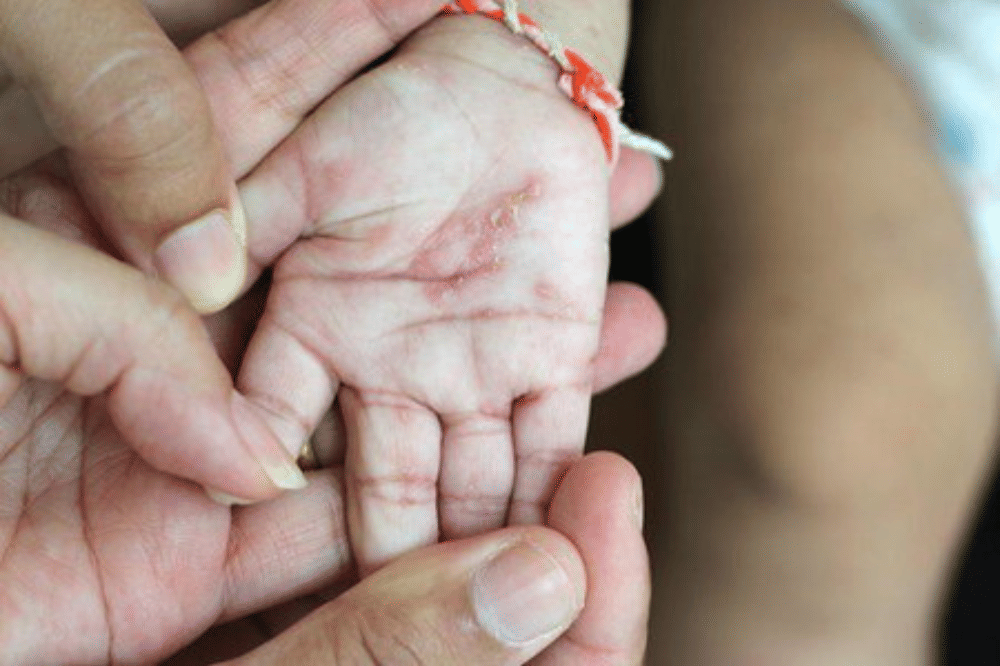 Apa Penyebab Scabies pada Bayi