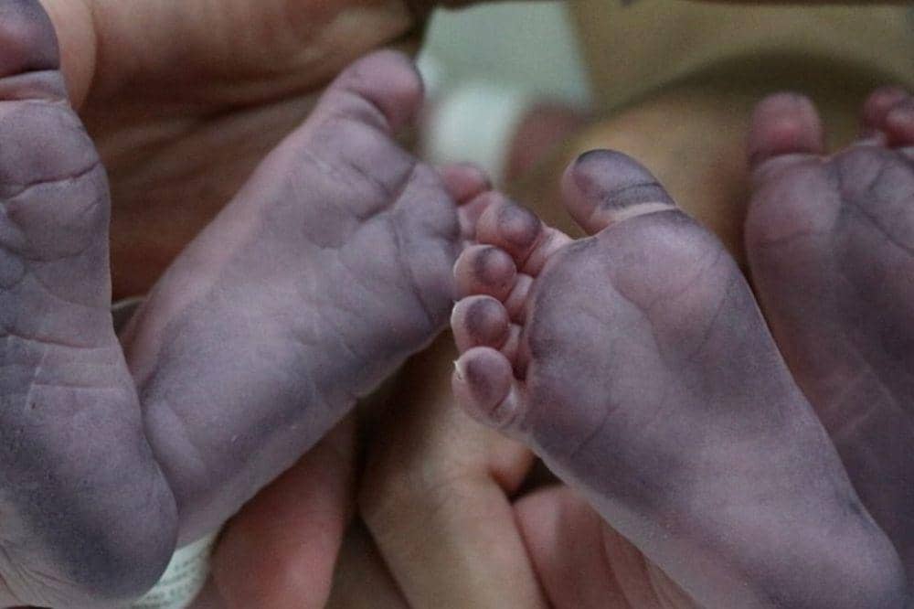 7 Penyebab Kulit Bayi Membiru, Salah Satunya karena Tersedak