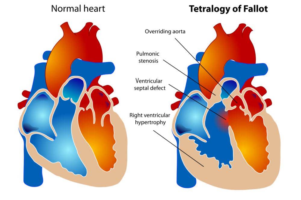Tetralogy of Fallot (TOF)