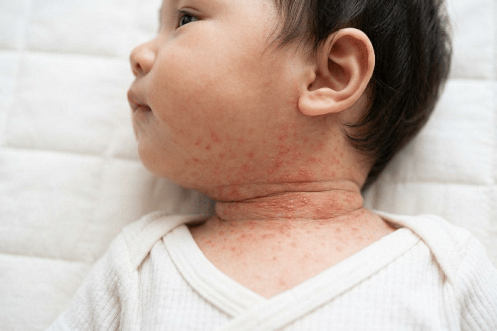 5 Obat Tradisional Biang Keringat pada Bayi, Ada Oat dan ASI!