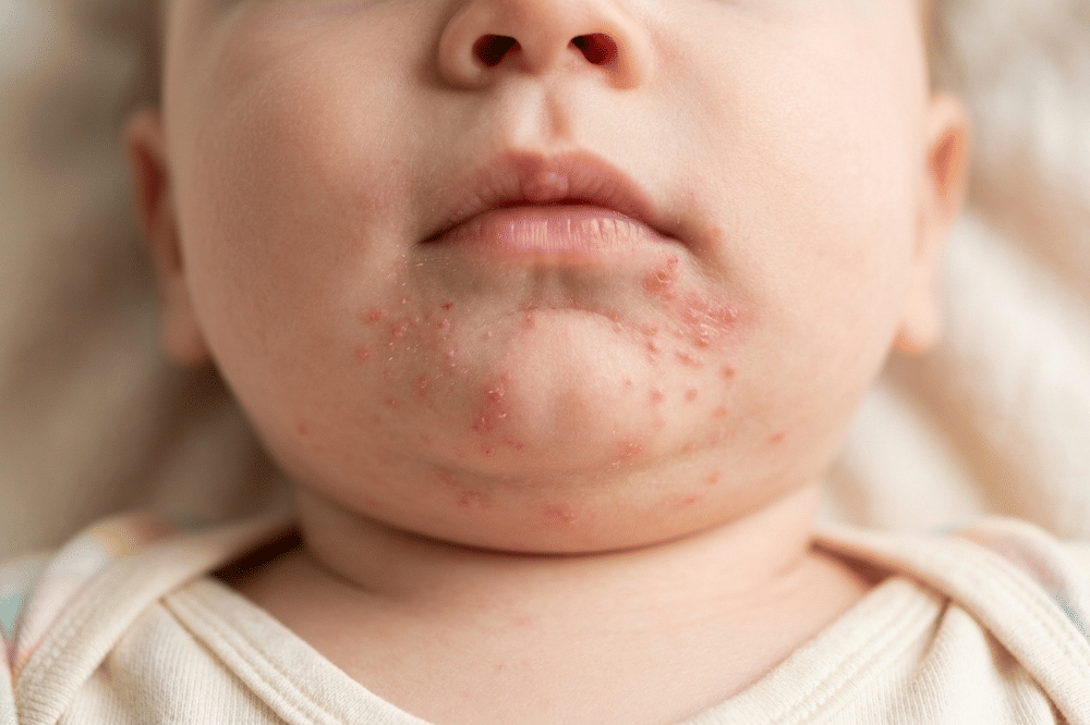 3 Cara Mengobati Herpes pada Bayi yang Perlu Diketahui Orangtua