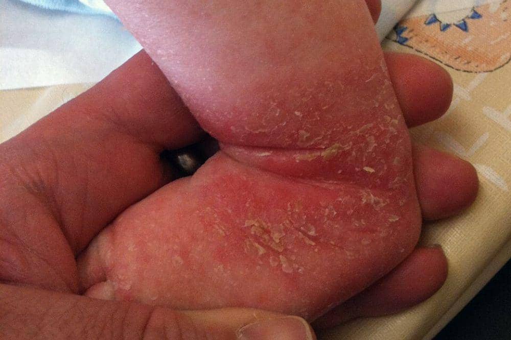 5 Cara Mengatasi Dermatitis Atopik pada Bayi agar Cepat Reda