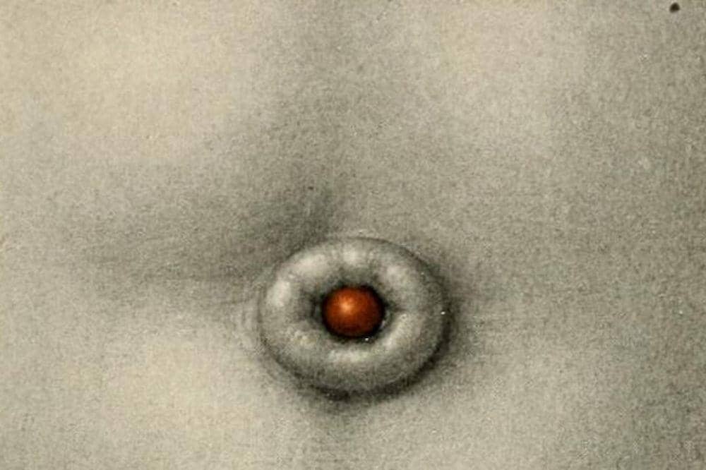 Granuloma umbilikalis