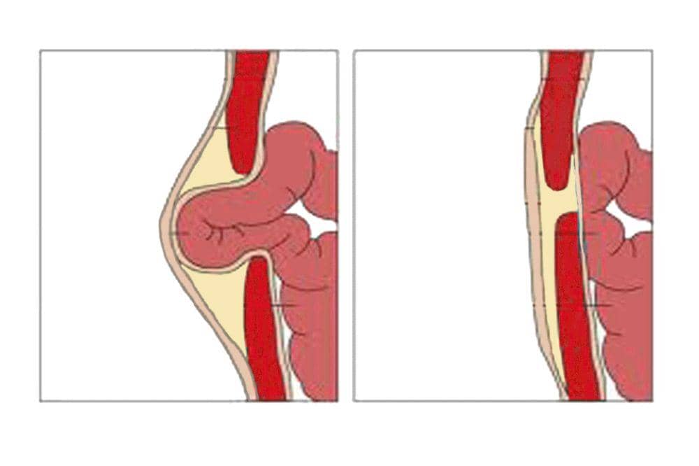 Hernia umbilikalis