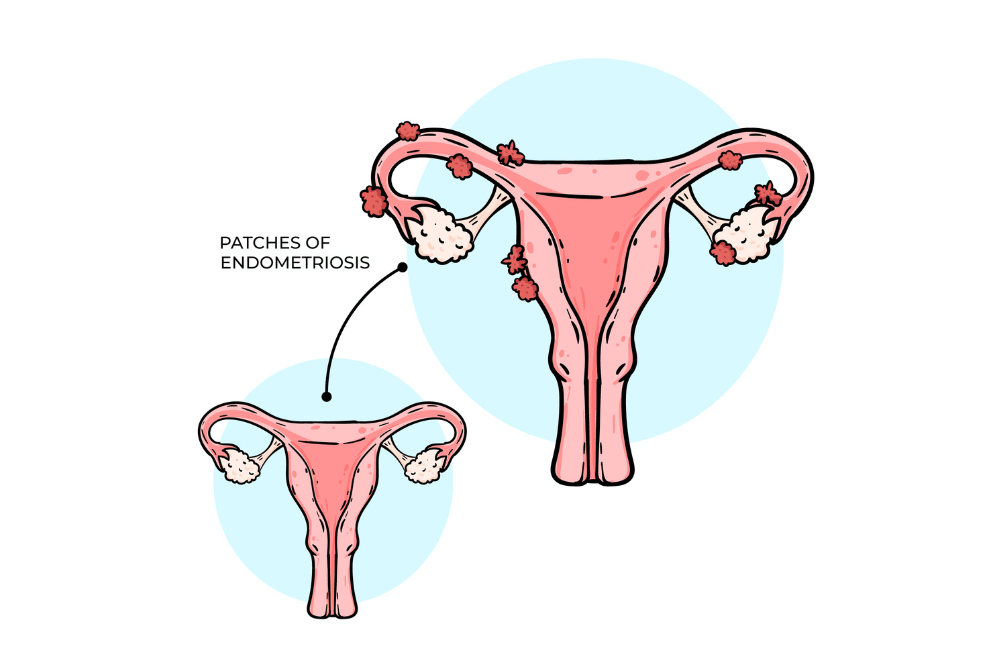Mengenal Endometrium dan Perannya dalam Program Hamil