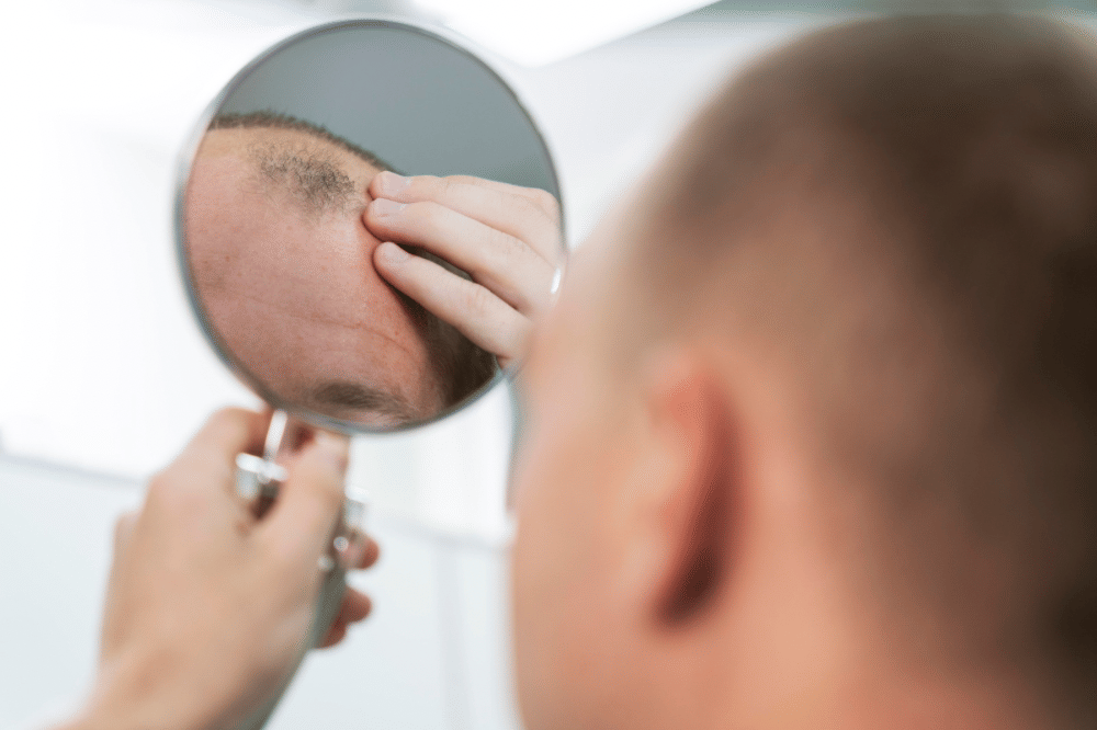 Bagaimana Alopecia Areata Ditangani?
