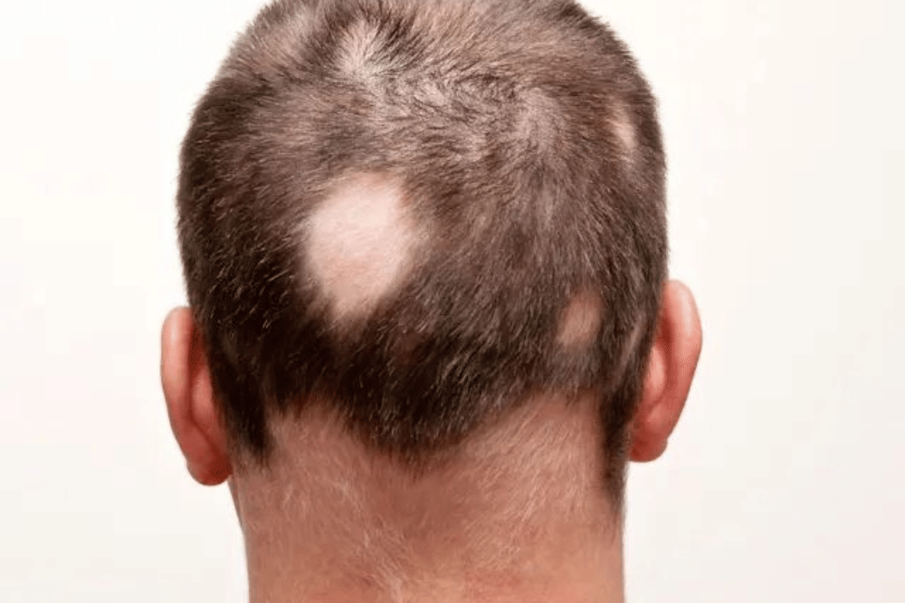 Apa itu Alopecia Areata?