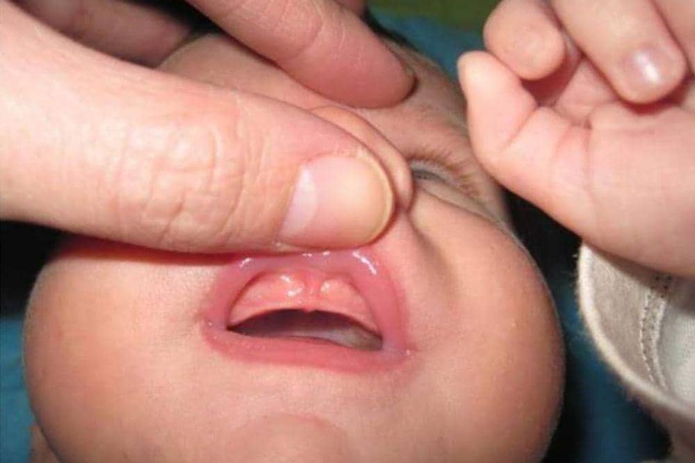 Apa Itu Lip Tie pada Bayi? Kenali Ciri dan Cara Mengatasinya