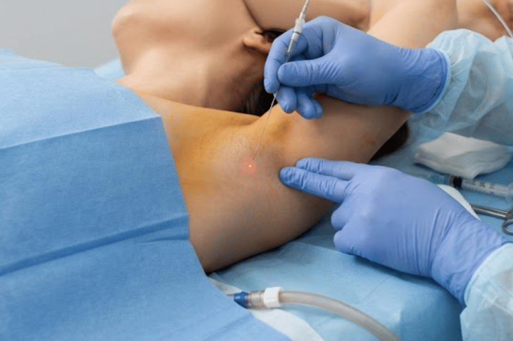 Prosedur Advanced Sweat Reduction