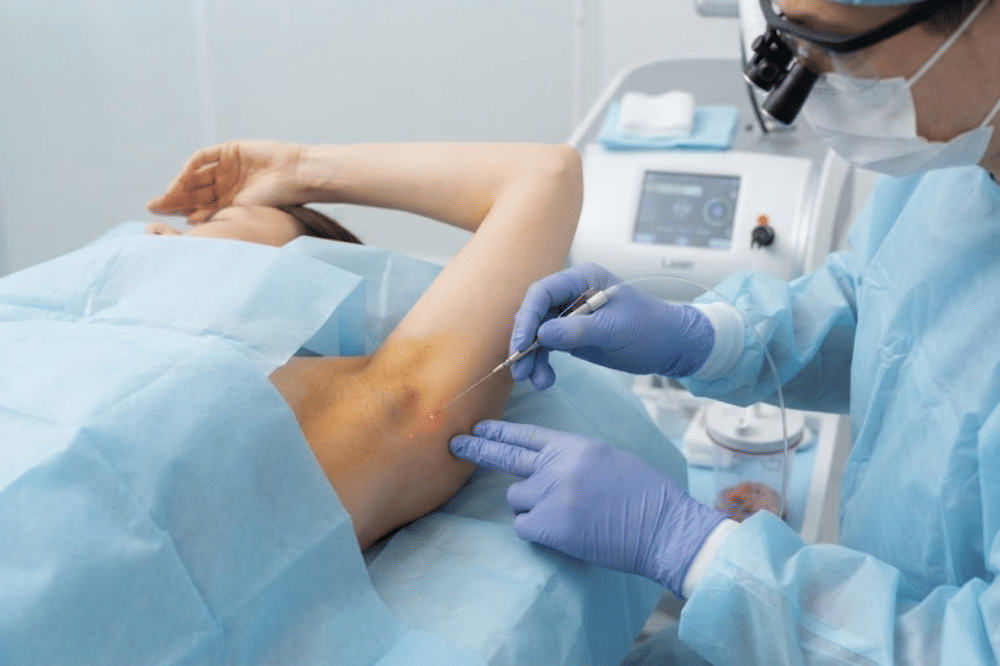 Penghancuran kelenjar keringat lewat Laser Assisted Liposuction