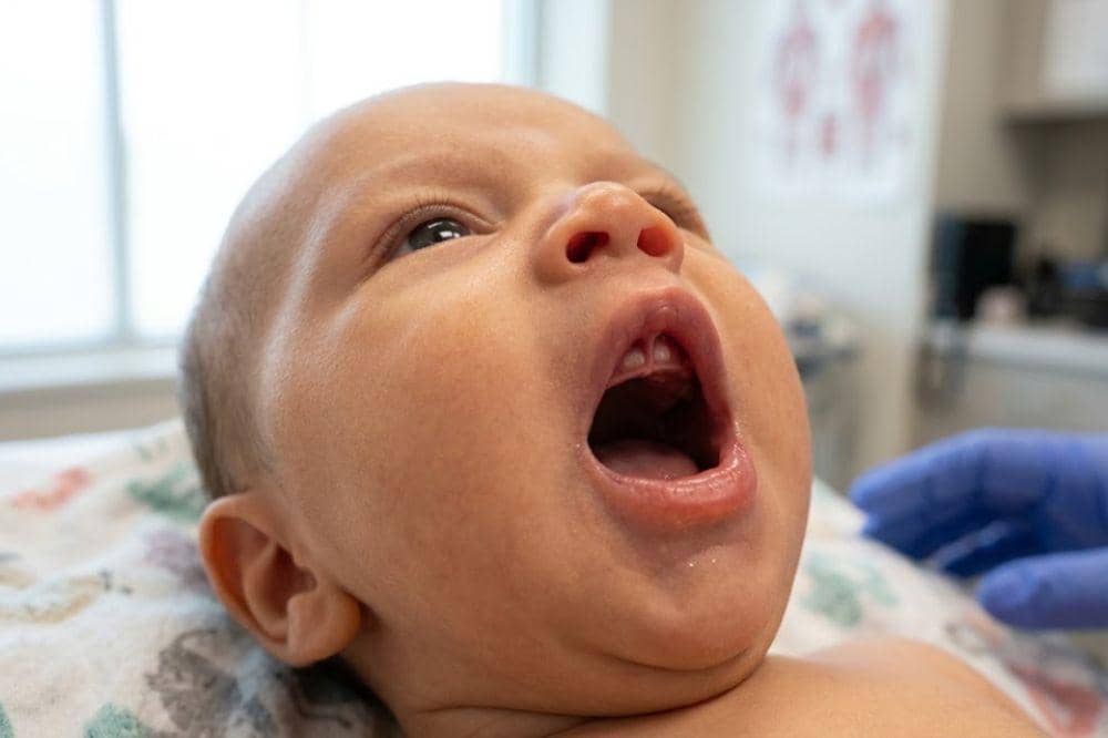 Pengertian Lip Tie pada Bayi
